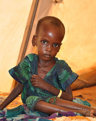 A_malnourished_child_in_an_MSF_treatment_tent_in_Dolo_Ado_2.jpg